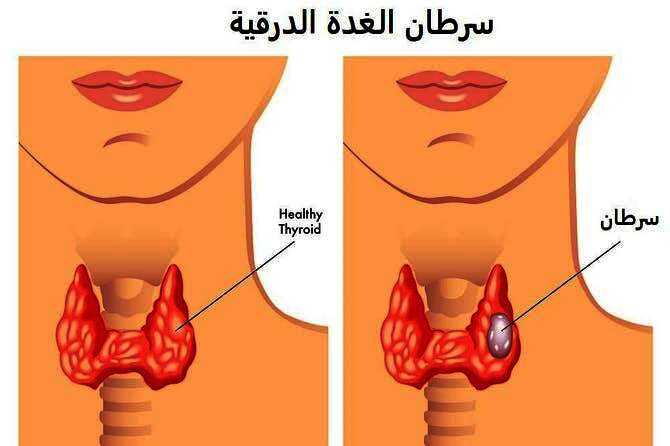 سرطان الغدة الدرقية