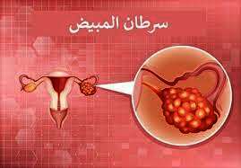 سرطان المبيض